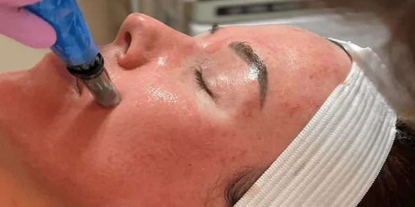 آموزش میکرونیدلینگ صورت